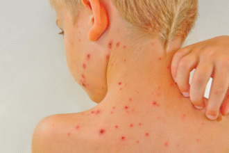 оперізуючий лишай