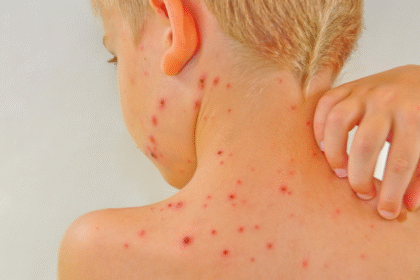 оперізуючий лишай