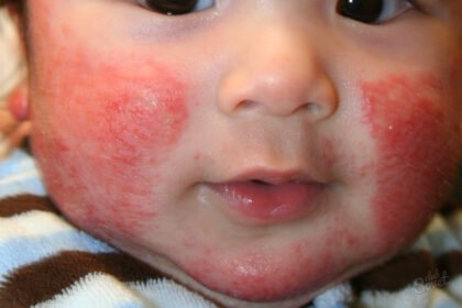 стафилококк