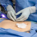 бариатрическая хирургия